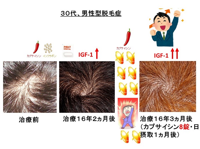 円形脱毛症　病院